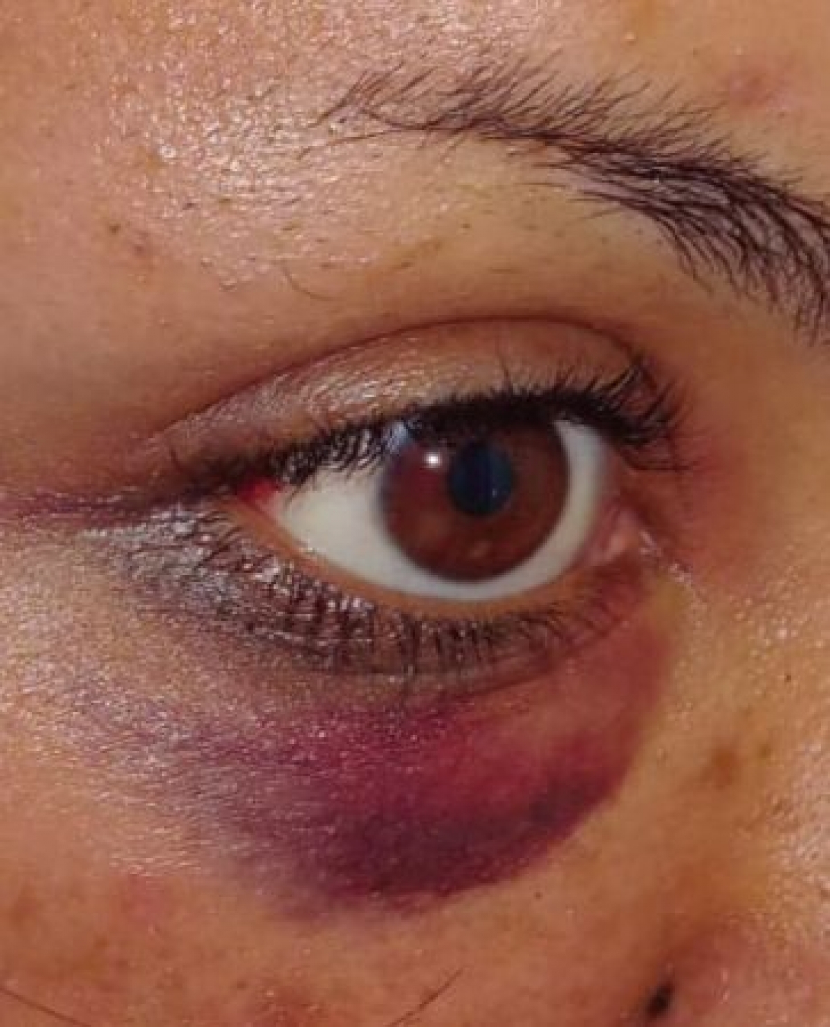 Hematoma y derrame ocular en ojo derecho de la victima